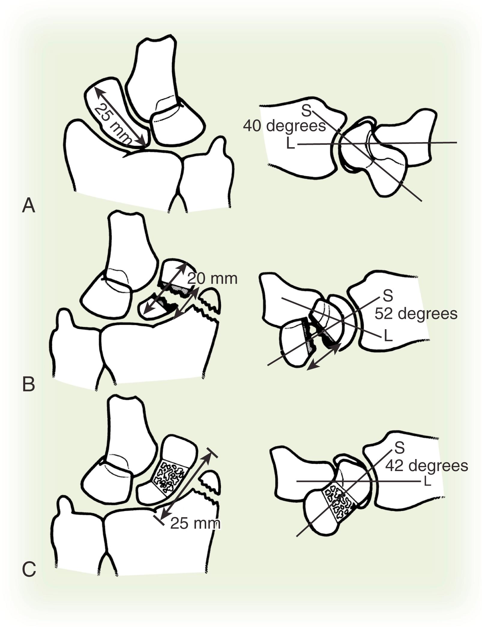 Fig. 16.20, A, Preoperative planning for insertion of a wedge-shaped graft. Tracing of the opposite uninjured wrist and measurement of scaphoid length and scapholunate angle. B, Calculation of size, resection area, and form of graft. C, Definitive diagram of the operation. L, Lunate; S, scaphoid.