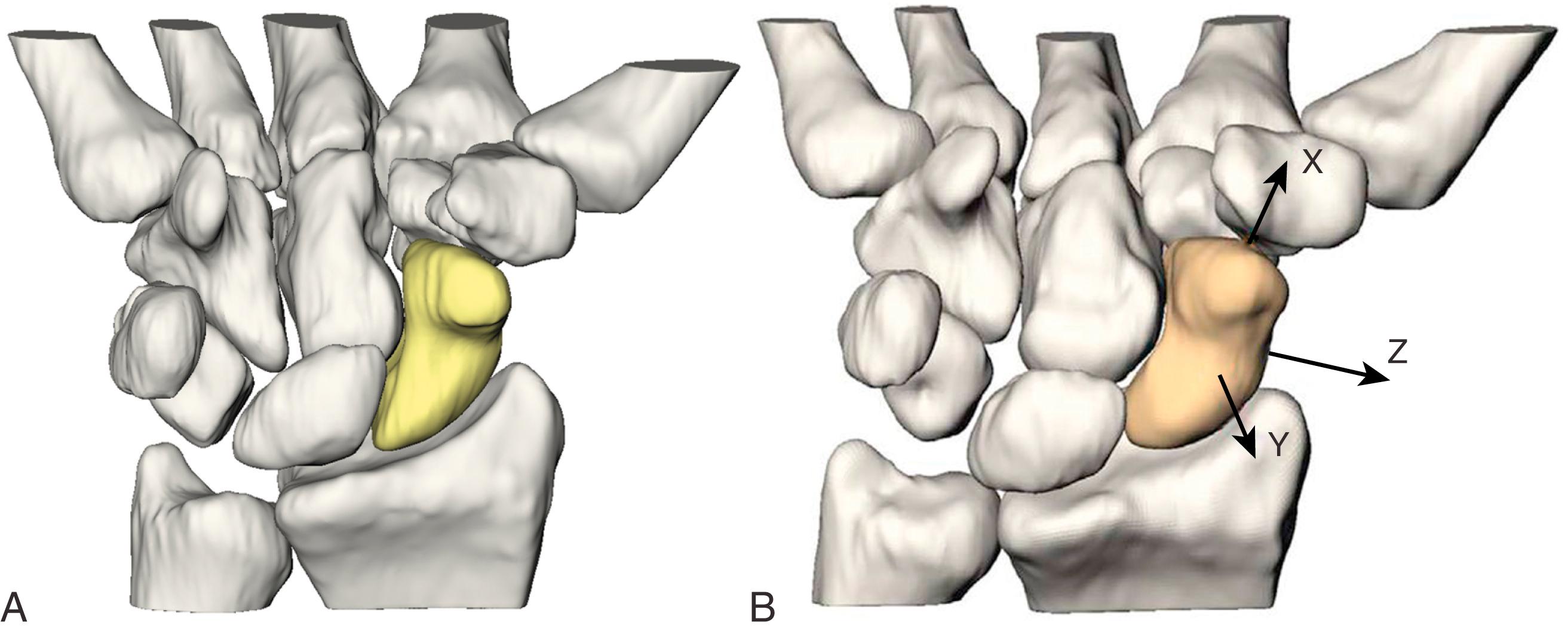 Fig. 16.2, A, A three-dimensional reconstruction of the scaphoid from CT images of 25 normal wrists. Note the scaphoid’s position spanning the proximal and distal carpal rows and acting as a “tie-rod” to coordinate smooth carpal motion. B, Eighty percent of the normal scaphoid surface is covered by articular cartilage. The scaphoid derives its name from its peculiar boat- or skiff-shaped contour. X, Rotation (pronation/supination); Y, sagittal (flexion/extension); Z, coronal (radial/ulnar).