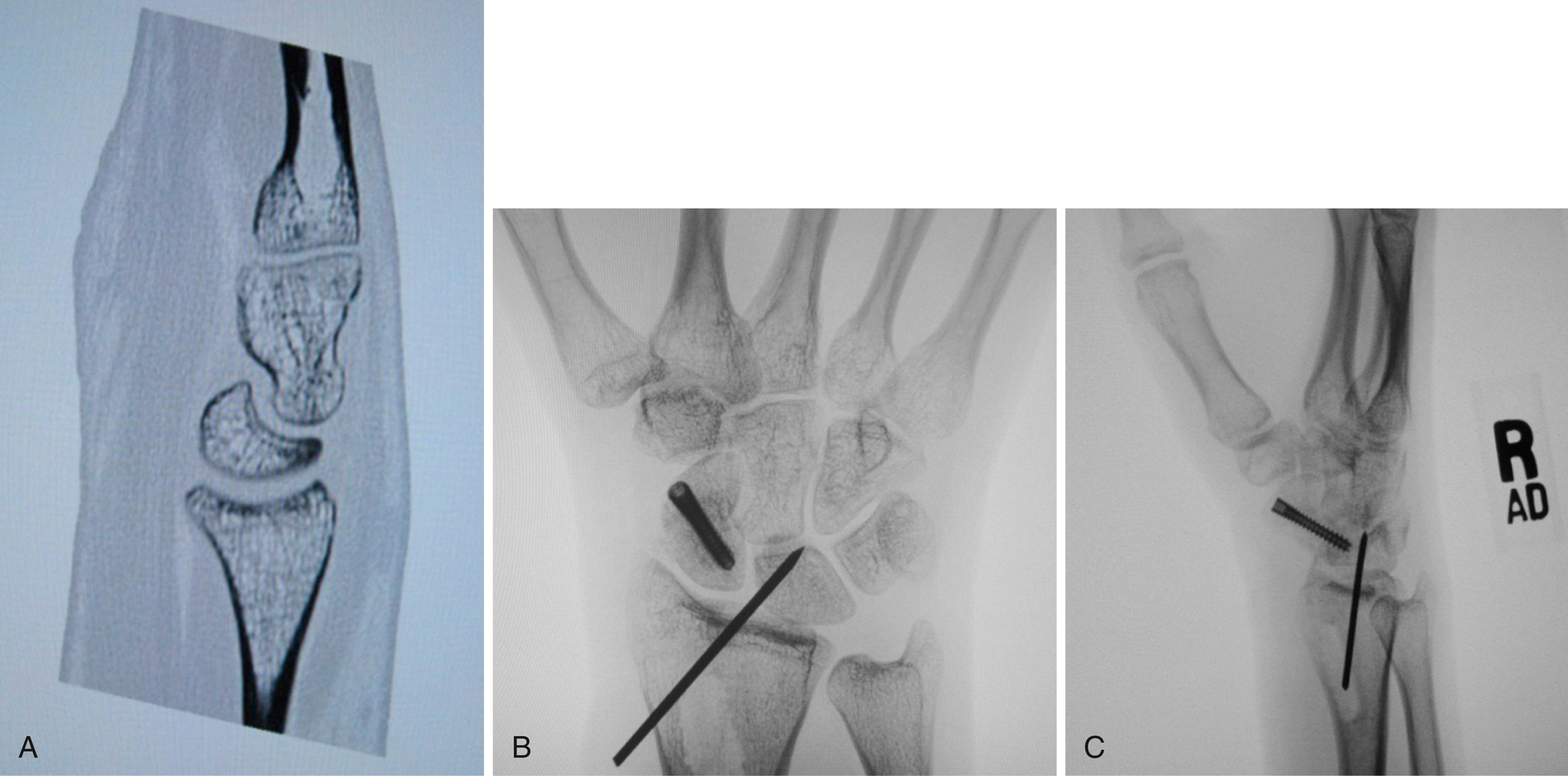 Fig. 16.21, A to C, Temporary radiolunate Kirschner wire fixation to reduce DISI in scaphoid nonunion surgery.