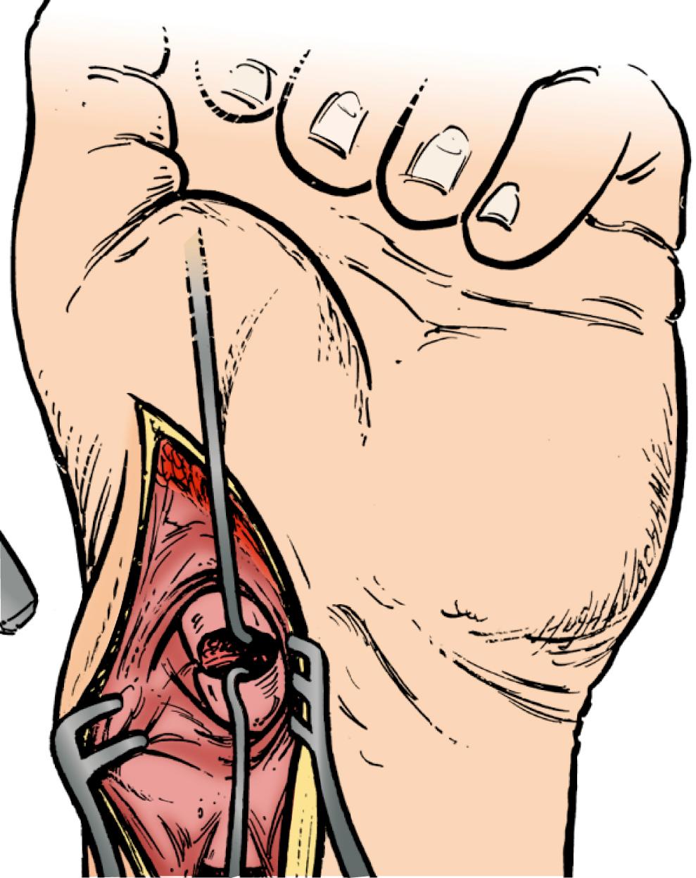 Fig. 16.22, Volar incision over flexor carpi radialis. Nonunion site is exposed with aid of skin hooks, and fibrous tissue is resected.