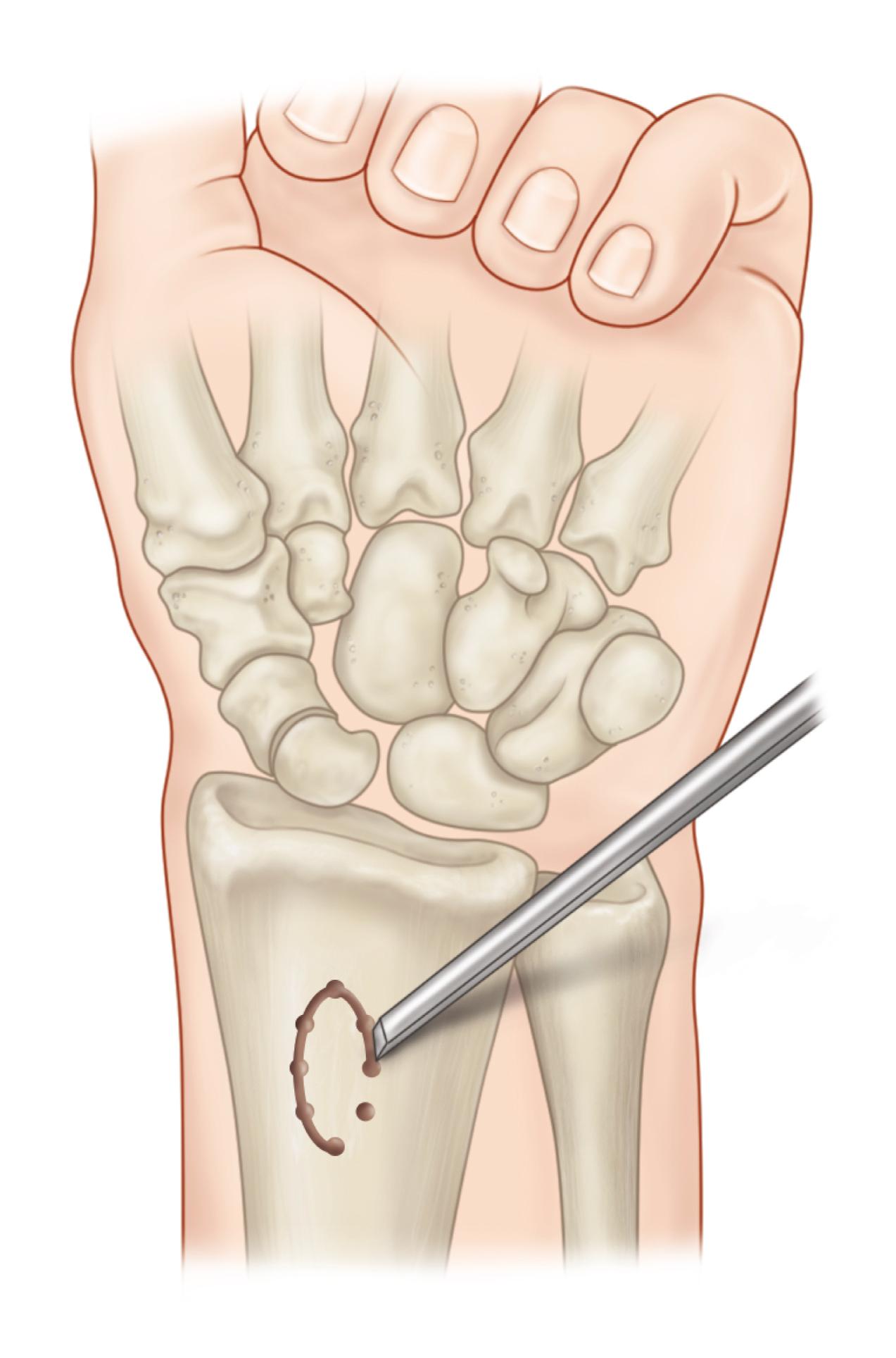 Fig. 16.23, A cortical window is made on the volar cortex of the distal radius. Cancellous bone graft is harvested.