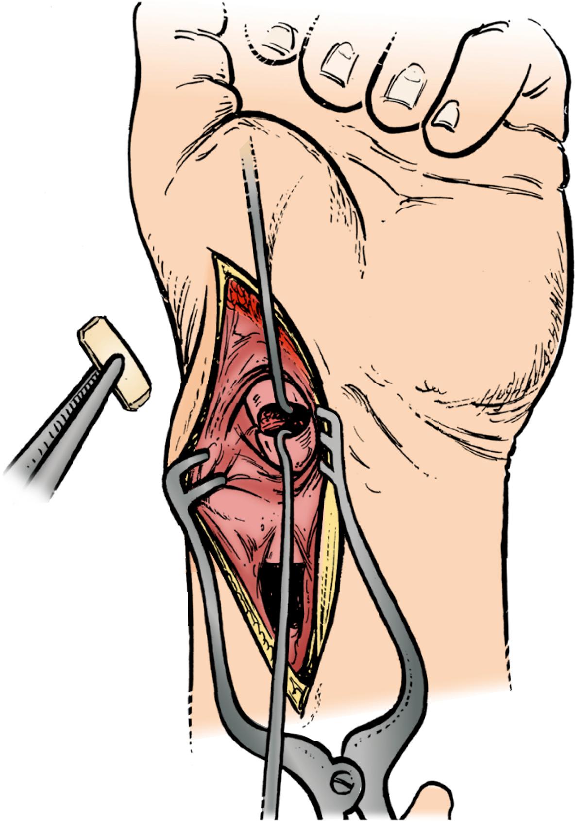 Fig. 16.24, A “matchstick” is made from the volar cortex of the distal radius and placed in the nonunion site in intramedullary fashion as a strut.
