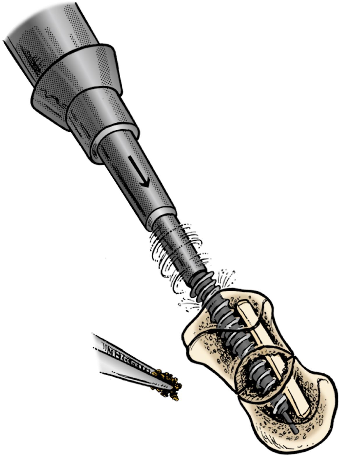 Fig. 16.25, Cancellous bone graft is packed in the remainder of the nonunion site, followed by fixation with a headless compression screw.