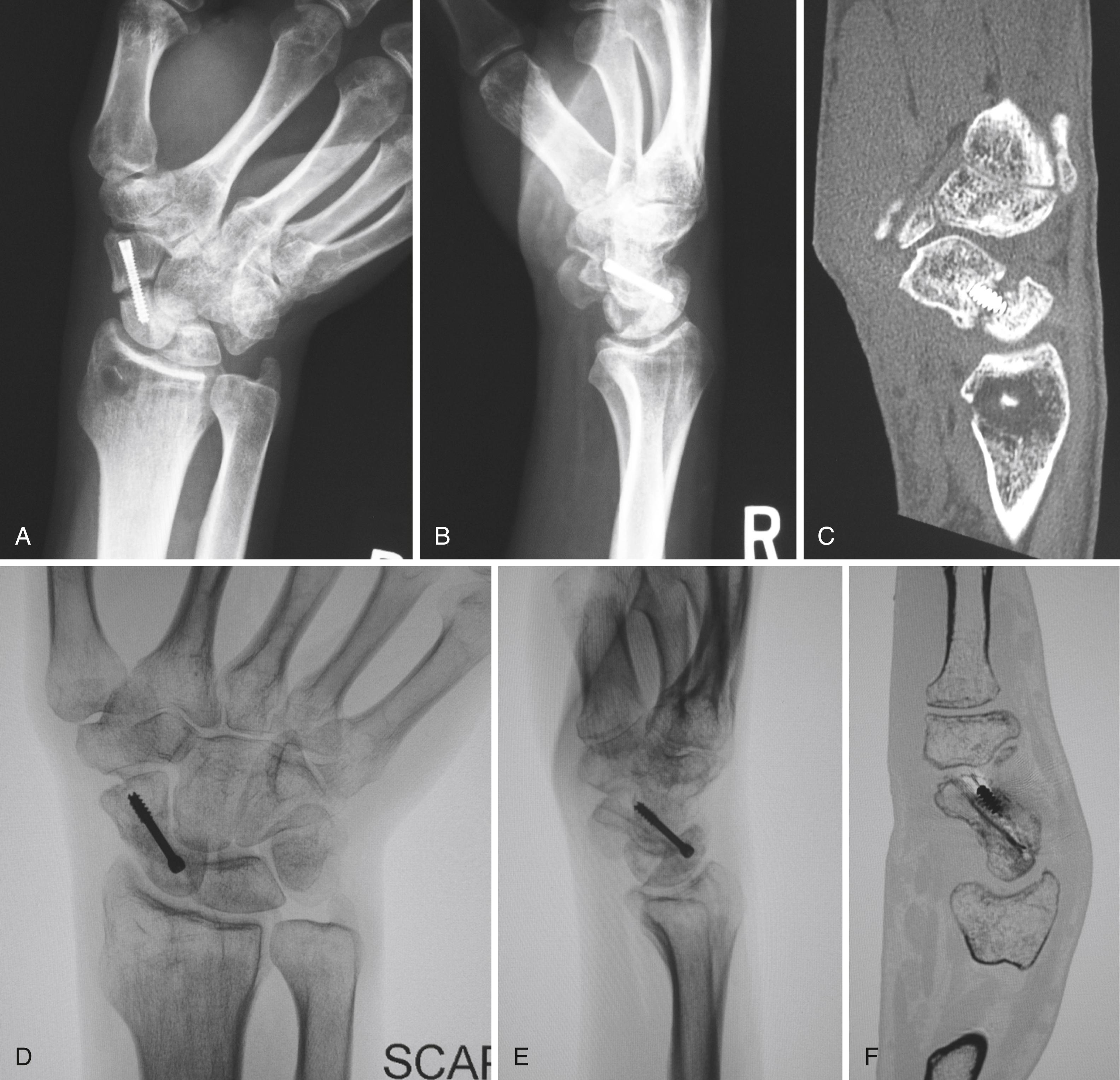 Fig. 16.28, A, Oblique radiograph of wrist showing scaphoid nonunion after attempted open reduction and internal fixation. B, Lateral wrist radiograph. C, Computed tomography (CT) scan, sagittal view. At 12 weeks following operation, healing is evident on scaphoid (D) and lateral (E) radiographs and sagittal CT scan (F) .