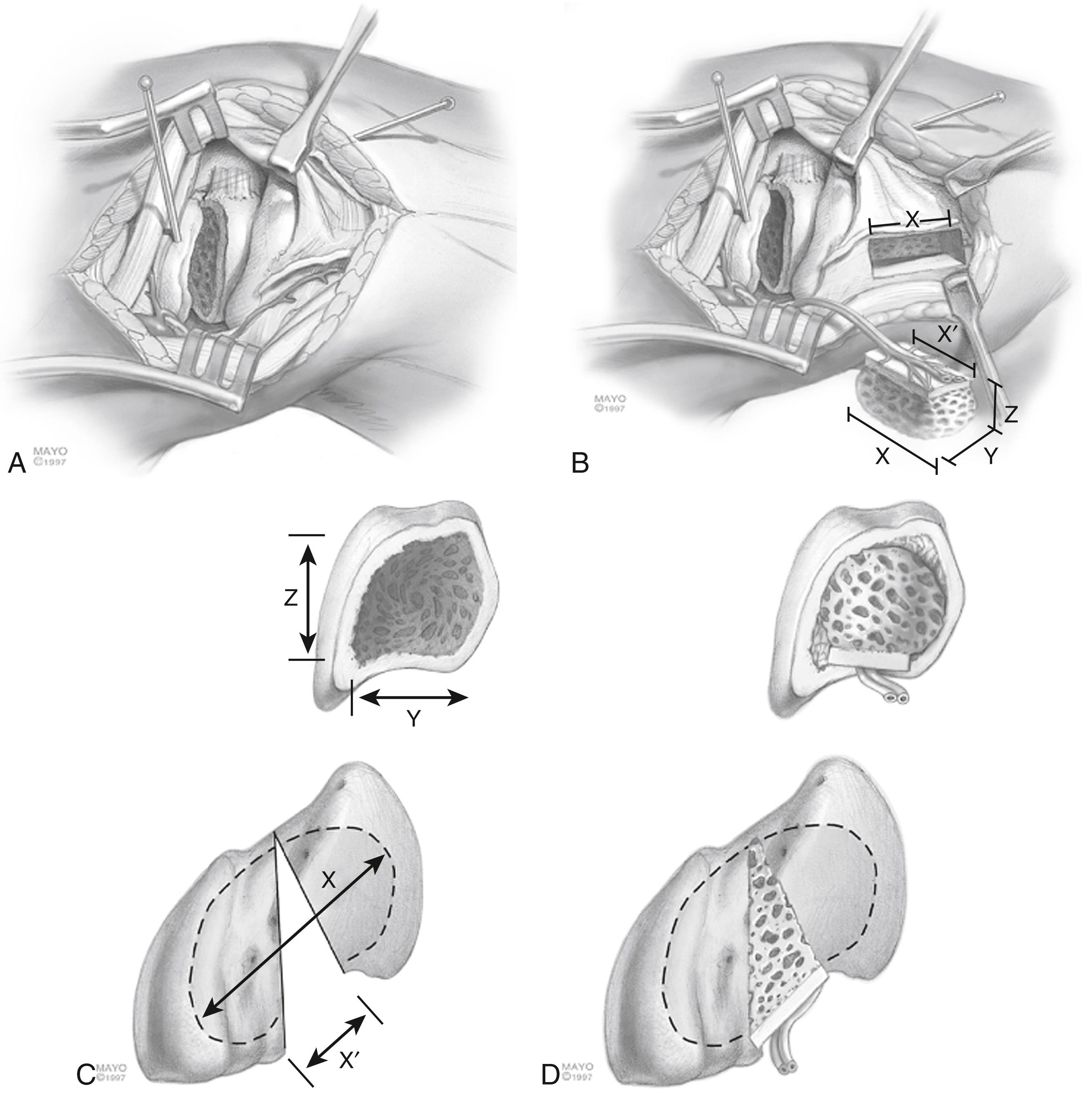 Fig. 16.30, Use of a dorsal radius 1,2 ICSRA vascularized graft in cases of malunion or humpback deformity. A, The scaphoid is prepared before graft elevation. B, A large graft is harvested that can be shaped into a wedge. C and D, The graft is trimmed to fit the defect dimensions and used as a volar strut. X, Length of intramedullary defect; X′, length of cortical gap; Y, width; Z, height.