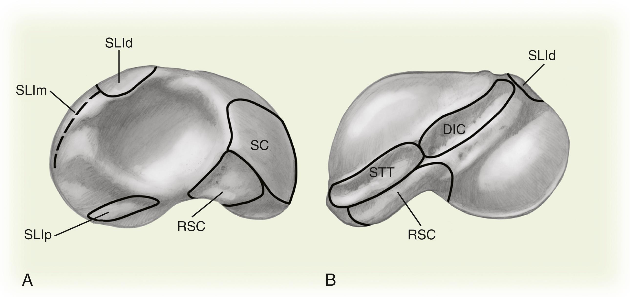 Fig. 16.3, Ligamentous attachments to the radial and ulnar aspects of the scaphoid. A, Medial surface of a right scaphoid demonstrating the attachment zones of the scaphocapitate (SC) ligament, the radioscaphocapitate ligament (RSC) , and the dorsal (SLId) , membranous (SLIm) , and palmar (SLIp) regions of the scapholunate interosseous ligament. B, Right scaphoid from a dorsoradial perspective demonstrating the attachment zones of the scaphotrapeziotrapezoid (STT) ligament, RSC, dorsal intercarpal ligament (DIC) , and SLId.