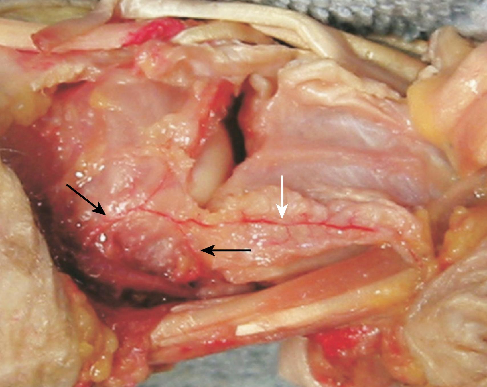 Fig. 16.32, The first and second compartments are incised at their attachments to bone near the 1,2 intercompartmental supraretinacular artery (ICSRA). The 1,2 ICSRA is mobilized as a pedicle.