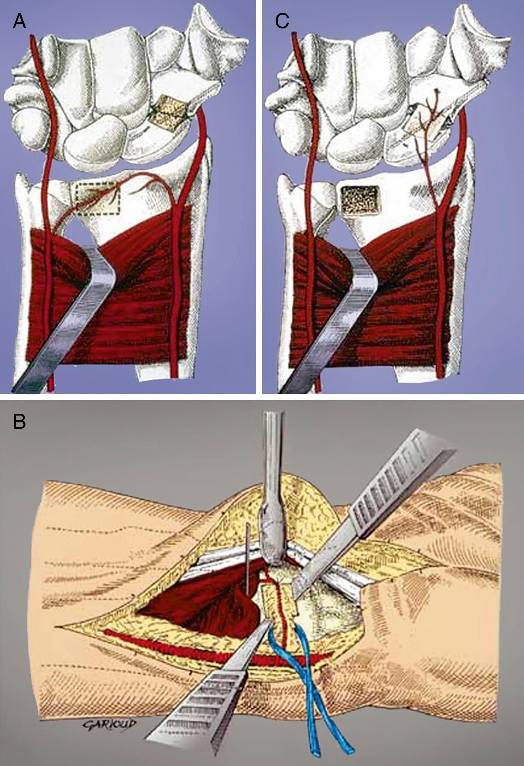 Fig. 16.33, Harvest and inset of the volar distal radius vascularized bone graft based on the radial contribution to the volar carpal artery. Donor site (A) , graft elevation with small osteotomes (B) , and inset (C) are noted. A small pyramid-shaped graft is harvested, and a small rim of fascia is taken around the pedicle during its subperiosteal dissection from the distal radius.