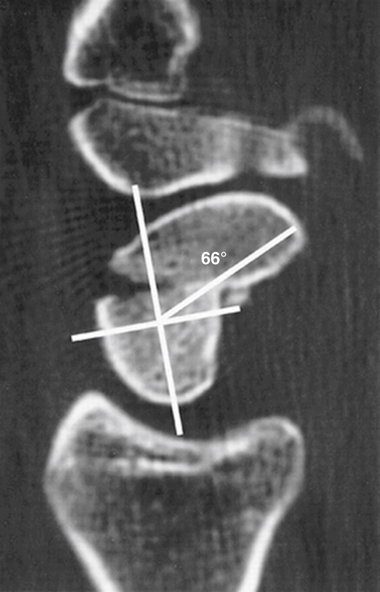 Fig. 16.5, Example of intrascaphoid angle of 66 degrees.