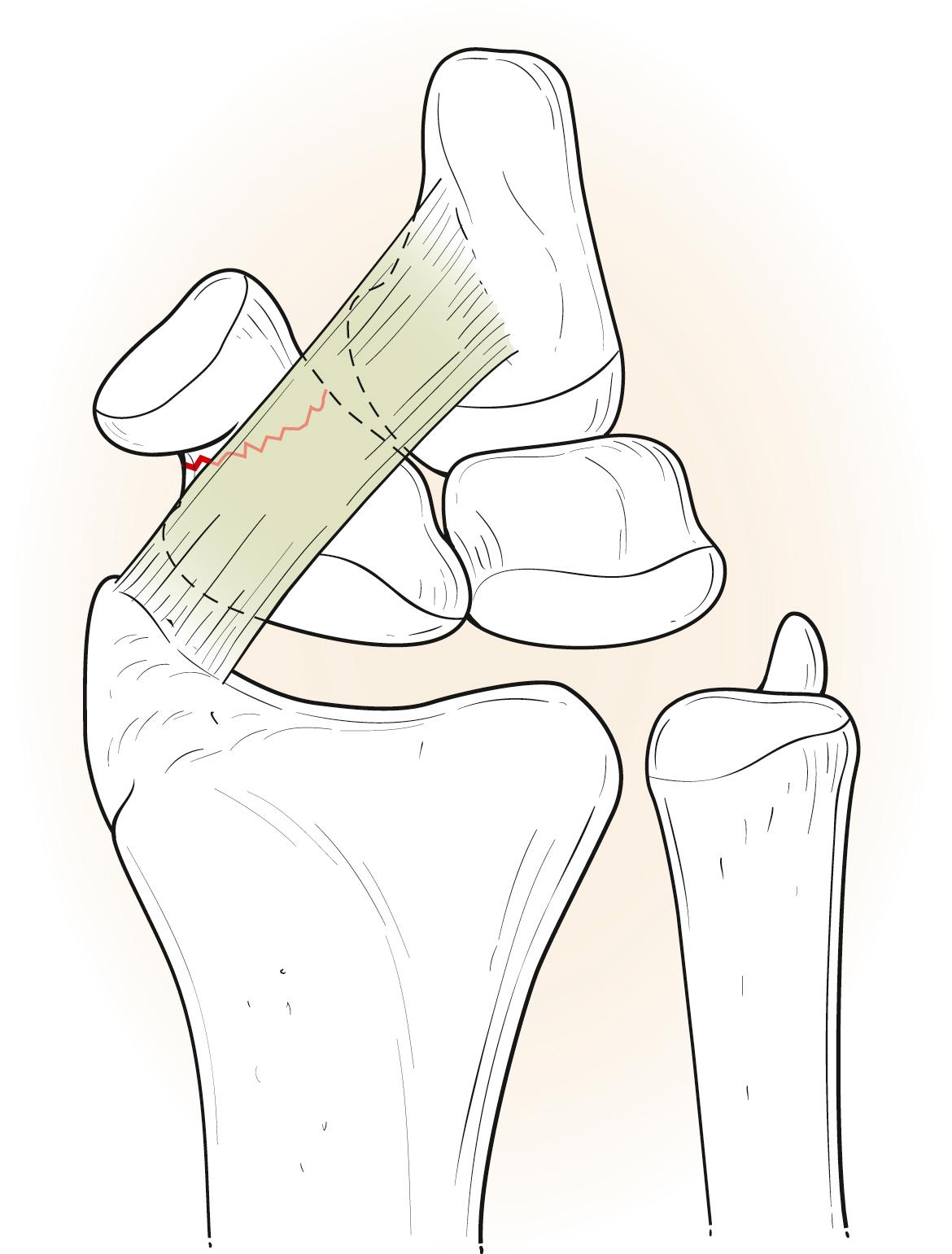 Fig. 16.6, The radioscaphocapitate ligament crosses the scaphoid waist and acts as a fulcrum over which the scaphoid fractures.