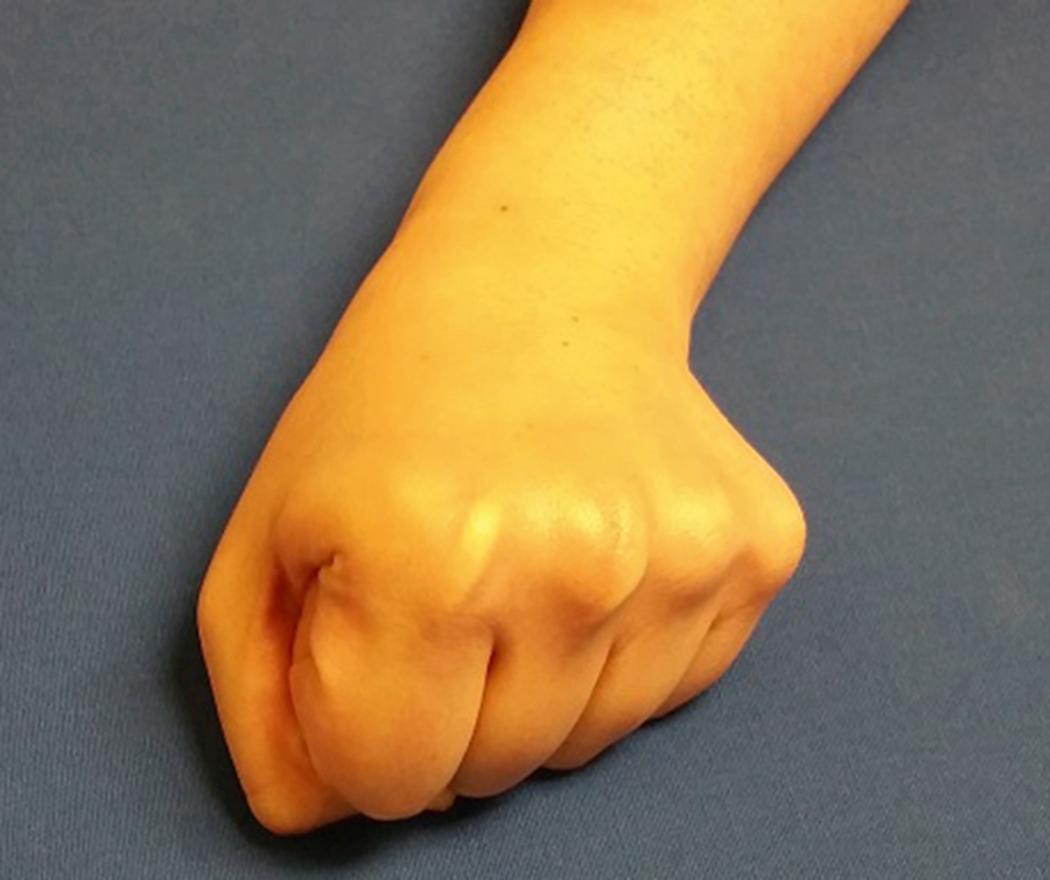 Fig. 16.7, Scaphoid view. The subject makes a fist and places the forearm and fist pronated palm side down with the wrist in ulnar deviation.