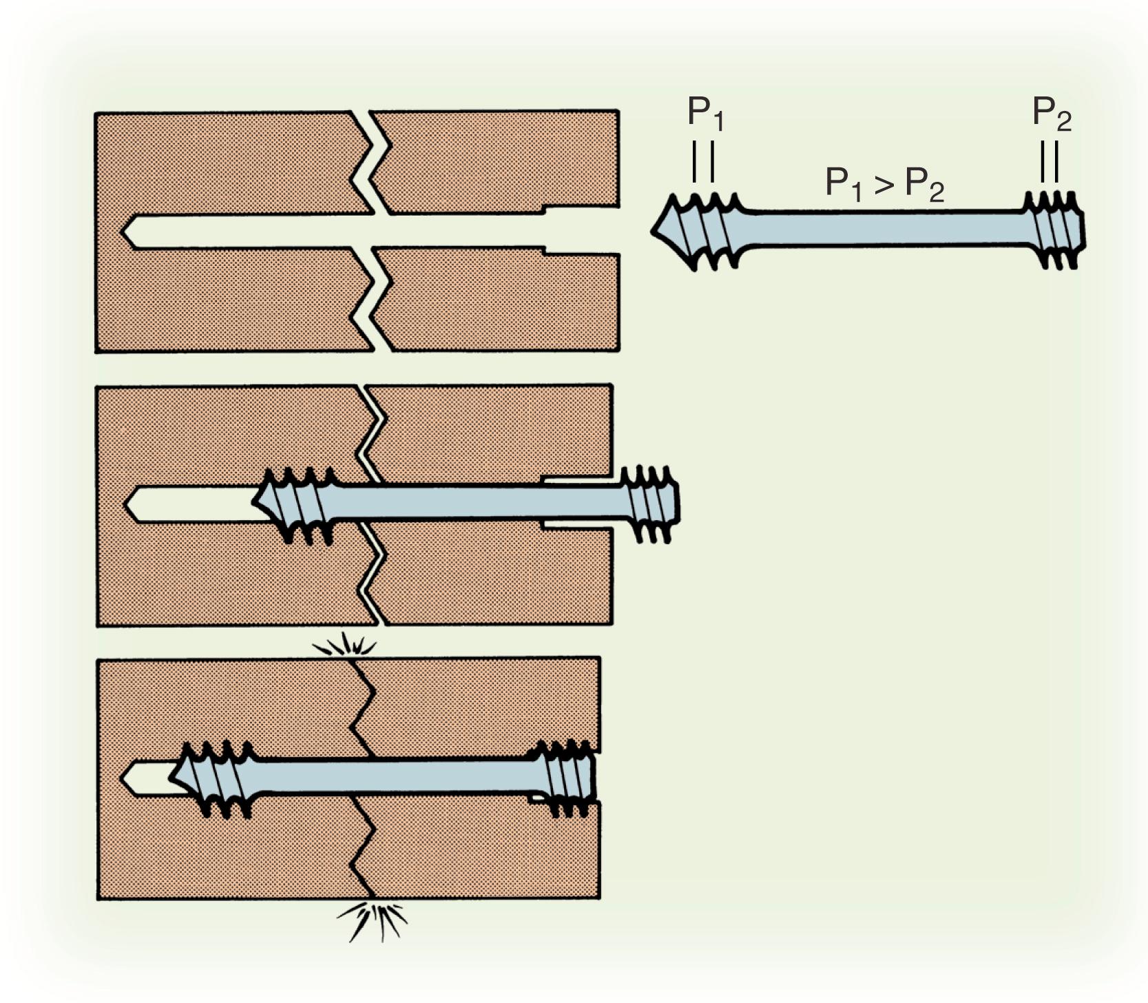 Fig. 16.9, The difference in pitch between the leading thread (P 1 ) and the trailing thread (P 2 ) of the Herbert screw governs the rate of “take-up,” or drawing together, of the two bone fragments to produce compression.