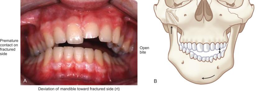 Fig. 1.15.3, (A) Occlusion of a patient with a fresh condylar process fracture on the right. Note the premature occlusion on the right side, deviation of the mandible to the right, and a left open-bite. (B) Illustration showing how a right condylar process fracture allows the right ramus to move upward causing the premature contact of teeth on that side, deviation of the mandible to that side, and the contralateral open-bite.