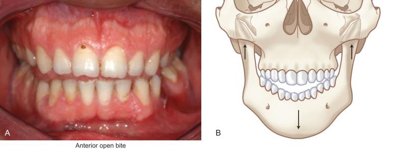 Fig. 1.15.4, (A) Occlusion of a patient with fresh bilateral condylar process fractures. Note the premature occlusion on the terminal molars and the anterior open-bite. (B) Illustration showing how bilateral condylar process fractures allow the mandibular rami to move upward, causing premature occlusion on the posterior teeth and an anterior open-bite.