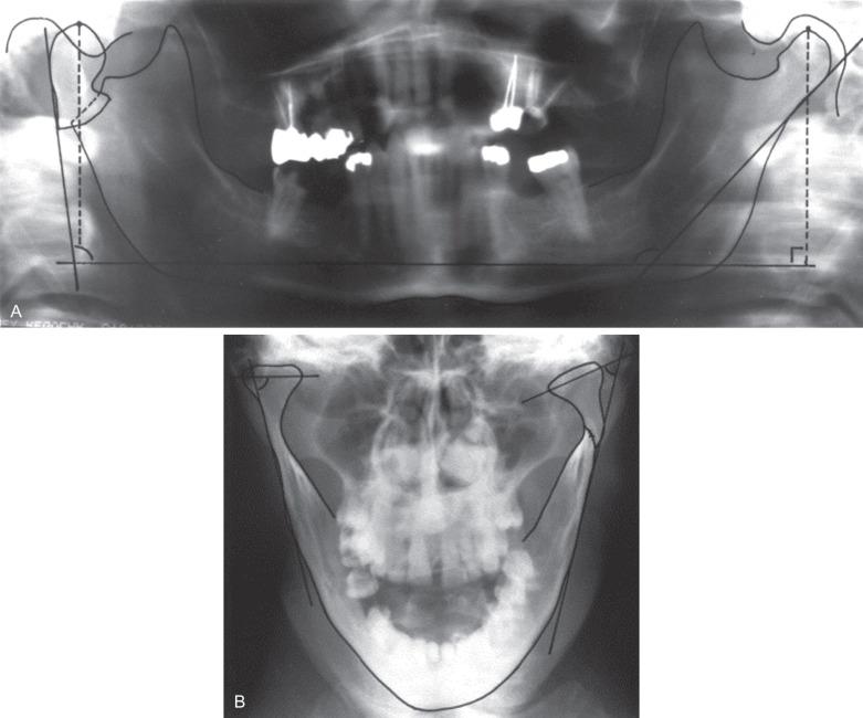 Fig. 1.15.5, Panoramic and Towne's radiographs of condylar process fractures. Note that the angle between the ramus and the condylar process can be quantified in both views.