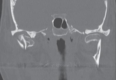 Fig. 1.15.6, CT scan of a patient with bilateral condylar process fractures. The condyle on the right is comminuted whereas the condyle on the left is luxated 90 degrees medially. Plain radiographs would not show this degree of detail.