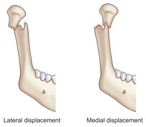 Fig. 1.15.7, Illustration showing lateral and medial displacement (override) of the fractured ends of a condylar process fracture.