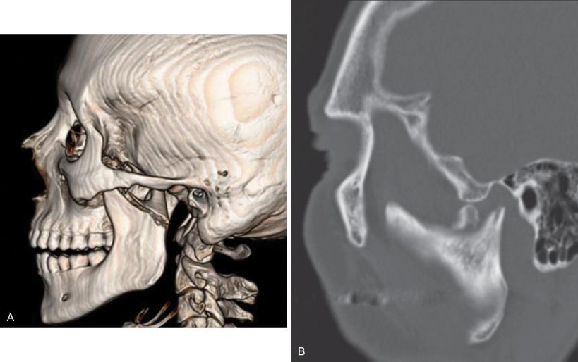 Fig. 1.15.8, CT scans of two completely dislocated condylar process fractures. Note that the articulating surface of the condyle is not in contact with the articulating surface of the glenoid fossa.