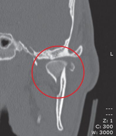 Fig. 1.15.9, CT of a diacapitular fracture. Note that the fracture line begins on the articular surface, goes through the head of the condyle and may extend outside the joint capsule on the medial side.