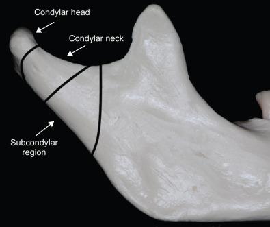 Fig. 1.15.10, Classification of condylar process fractures by location (head, neck, subcondylar).