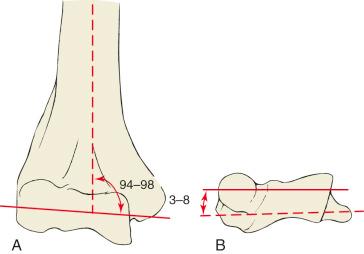 Fig. 45.3, The axis of the trochlea is in valgus with respect to the longitudinal axis of the distal end of the humerus (A) and in external rotation with respect to the transverse axis (B).