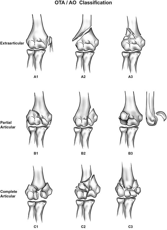 Fig. 45.7, Orthopaedic Trauma Association/Arbeitsgemeinschaft für Osteosynthesefragen (OTA/AO) classification of distal humerus fractures.