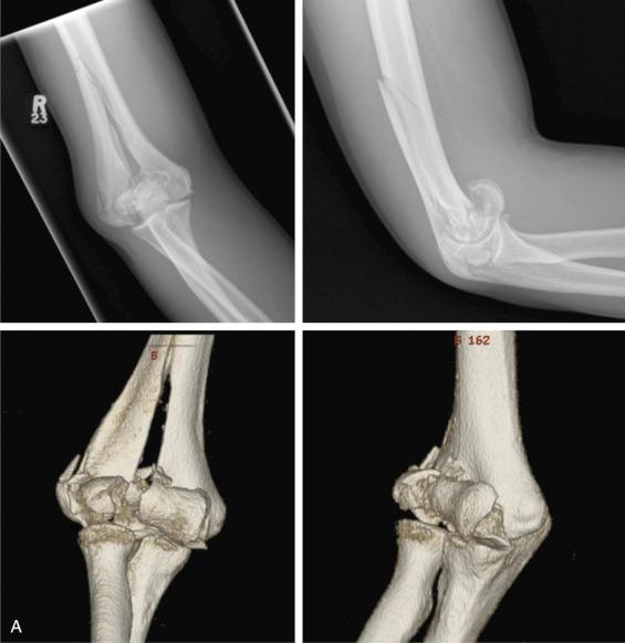 Fig. 45.8, (A) Preoperative radiographs and three-dimensional (3-D) computed tomography (CT) scan of a comminuted C3-type fracture of the right distal humerus in a young male patient with high-energy trauma on a motorcycle. Although the medial column is intact, which is unusual, this is a C-type fracture because the articular surface is completely separated from the shaft of the humerus. The 3-D CT reconstructions help to clarify the articular comminution and coronal fracture lines in both the trochlea and capitellum. (B) One-year postoperative radiographs in the same patient showing anatomic reduction and healing obtained through an olecranon osteotomy approach. Because the medial column was intact, a plate was not used on this column; rather, two plates were used on the comminuted lateral column.