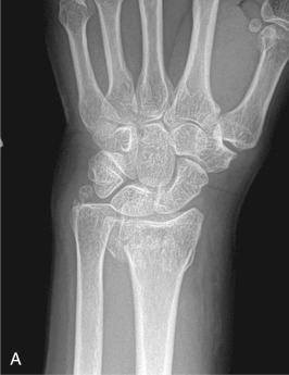 Fig. 42.11, Posterior-anterior (PA; A), oblique (B), and lateral (C) views demonstrating a displaced intraarticular distal radius fracture. A three-dimensional (3-D) reconstruction image (D) still fails to fully demonstrate the relationship of the intraarticular fragments; however the same view with the carpus and hand subtracted (E) and especially rotated views to look more directly at the articular surface (F and G) truly demonstrate the personality of this four-part fracture.