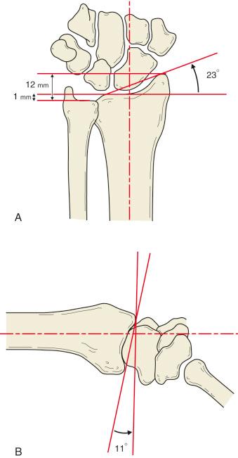 Fig. 42.2, (A) Measurements of radiographic parameters of the distal radius and ulna. Radial inclination, measured off the perpendicular to the radial shaft, averages 23 degrees. Radial length is the difference in length between the ulnar head and the tip of the radial styloid (average, 12 mm). Ulnar variance depicts the difference in length between the ulnar head and the ulnar aspect of the distal radius (shown as 1 mm ulnar negative). (B) Palmar tilt, as determined on the lateral radiograph, averages 11 degrees.