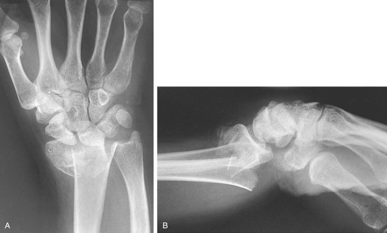Fig. 42.4, Posterior-anterior (A) and lateral (B) radiographs of an extraarticular fracture of the distal radius with significant displacement and disruption of the distal radioulnar joint.
