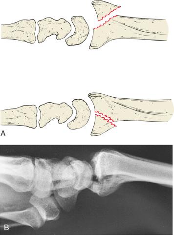 Fig. 42.5, The two-part fracture. (A) Schematic of the dorsal and palmar Barton fracture-subluxation. (B) Lateral radiograph of a volar Barton fracture. These are inherently unstable injury patterns associated with shear forces.