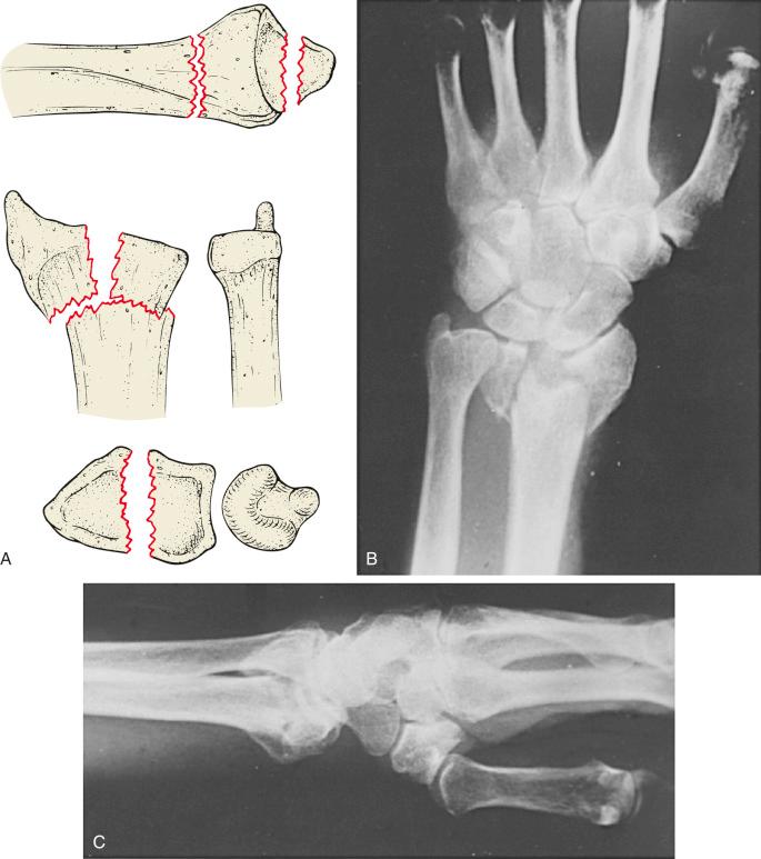 Fig. 42.6, The three-part fracture. Schematic (A) and posterior-anterior (B) and lateral (C) radiographs of a three-part fracture. Note the separation of the radial styloid (scaphoid facet) from the entire lunate facet of the distal radius.