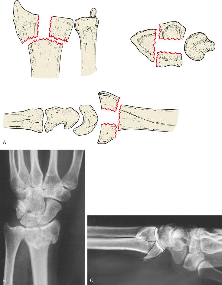 Fig. 42.7, The four-part fracture. Schematic (A) and posterior-anterior (B) and lateral (C) radiographs of a four-part fracture of the distal radius. Note the coronal split of the lunate facet into dorsal and volar fragments. This produces instability dorsally and volarly and may require a combined dorsal and palmar approach (if the dorsal lunate facet fragment cannot be reduced by closed methods).