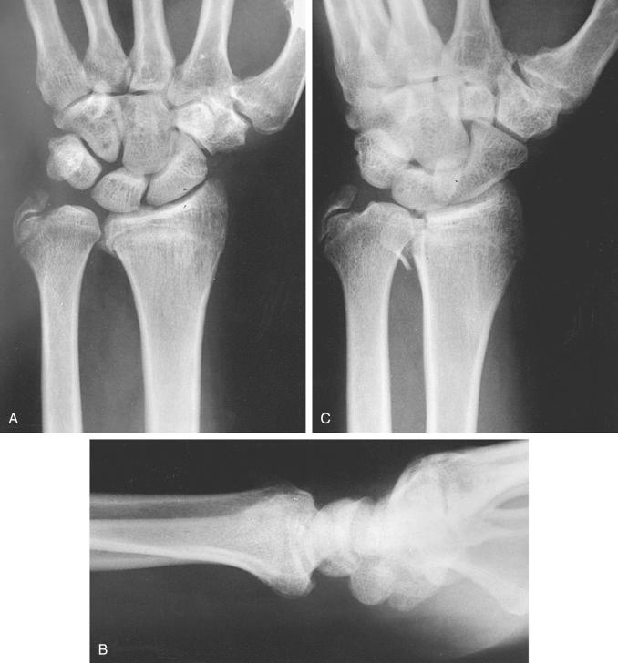 Fig. 42.8, Posterior-anterior (A) and lateral (B) views of the distal radius of a 50-year-old laborer after a fall. An old ulnar styloid deformity is evident with no obvious injury to the radius. (C) Partially supinated oblique radiograph reveals displaced dorsal portion of the lunate facet (die-punch fracture).