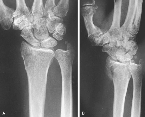 Fig. 42.9, (A) Posterior-anterior view of the distal radius, revealing no obvious fracture. (B) Partially pronated oblique radiograph demonstrates displaced radial styloid fracture. This view best projects the radial styloid process.