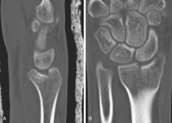 Fig. 42.10, Sagittal (A) and coronal (B) computed tomography images depicting a die-punch injury to the distal radius.