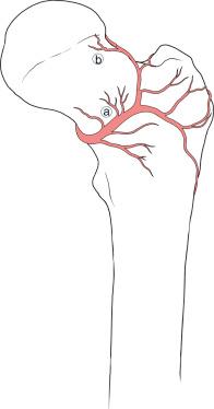 Fig. 12.1, Diagram showing the deep branch of the medial femoral circumflex artery (A) and its ascending branches. The terminal subsynovial branches of the medial femoral circumflex artery (B) are located on the posterosuperior aspect of the neck of the femur and are at risk of injury from intramedullary nailing with a start site in the piriformis fossa.