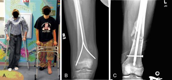 Fig. 12.3, (A) These two adolescent males were seen in the emergency department within an hour of each other. They were both 14 years of age. (B) The patient on the left had a smaller intramedullary canal. He was treated successfully with flexible intramedullary nailing. (C) The patient on the right had physes that were nearly closed, and he weighed 80 kg. He was treated with rigid intramedullary nailing. Age alone is a poor determinant of treatment options.