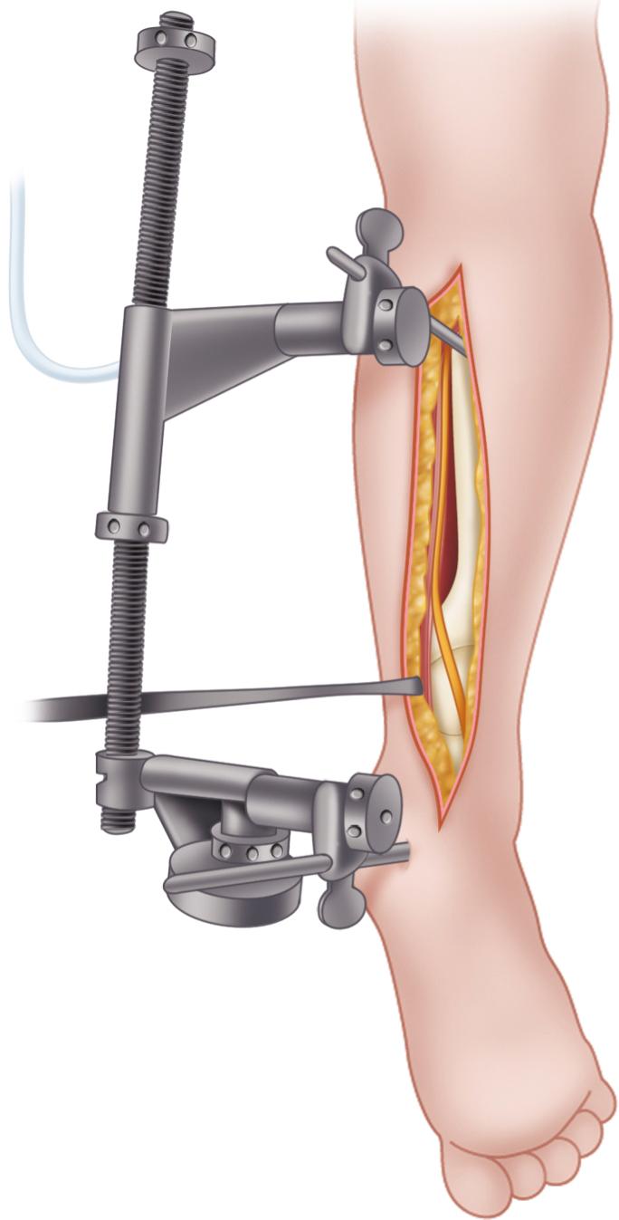 FIGURE 54.18, Posterior approach. Femoral distractor has been applied, and sural nerve is dissected free. SEE TECHNIQUE 54.8 .