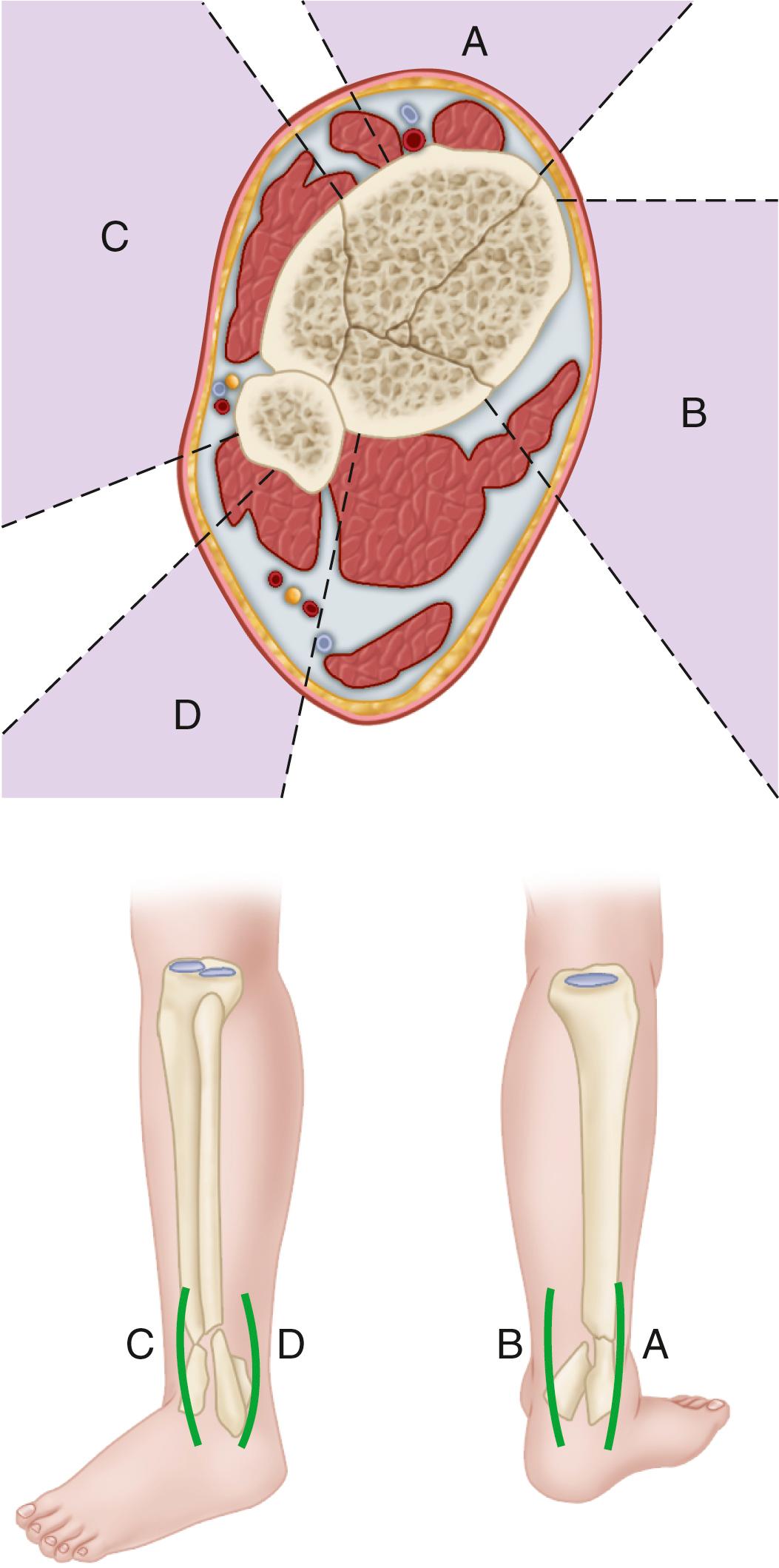FIGURE 54.21, Fracture patterns found on CT scans of pilon fracture: anterolateral, posterolateral, anteromedial, or posteromedial fragments with central impaction or compression. Based on anatomically safe corridors, wires can be passed obliquely through safe zones A and D or B and C ; wires cannot be passed safely directly from anterior to posterior. Safe zones A, B, C, and D correspond to incisions.