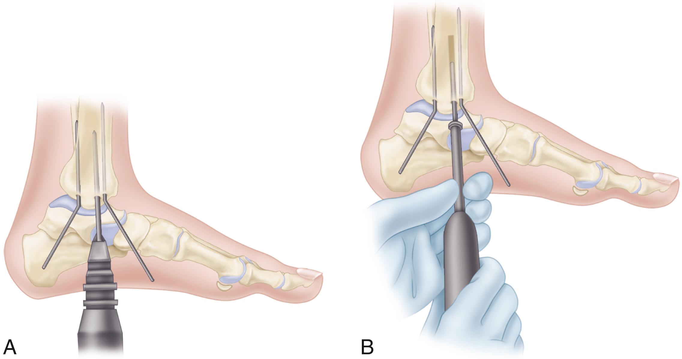 FIGURE 54.6, A, AO technique for internal fixation of medial malleolus. Hole (3.2 mm) is drilled while distal fragment is held reduced with two Kirschner wires bent to stay out of way. Length of hole is measured. B, Insertion of malleolar screw without tapping. Kirschner wires are removed after screw is tightened. If fragment tends to rotate, additional smaller screw or compression wiring can be added. SEE TECHNIQUE 54.2 .