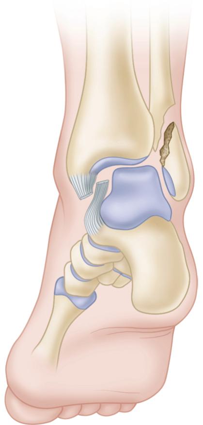 FIGURE 54.8, Deltoid ligament after being avulsed from medial malleolus may be caught between malleolus and talus.