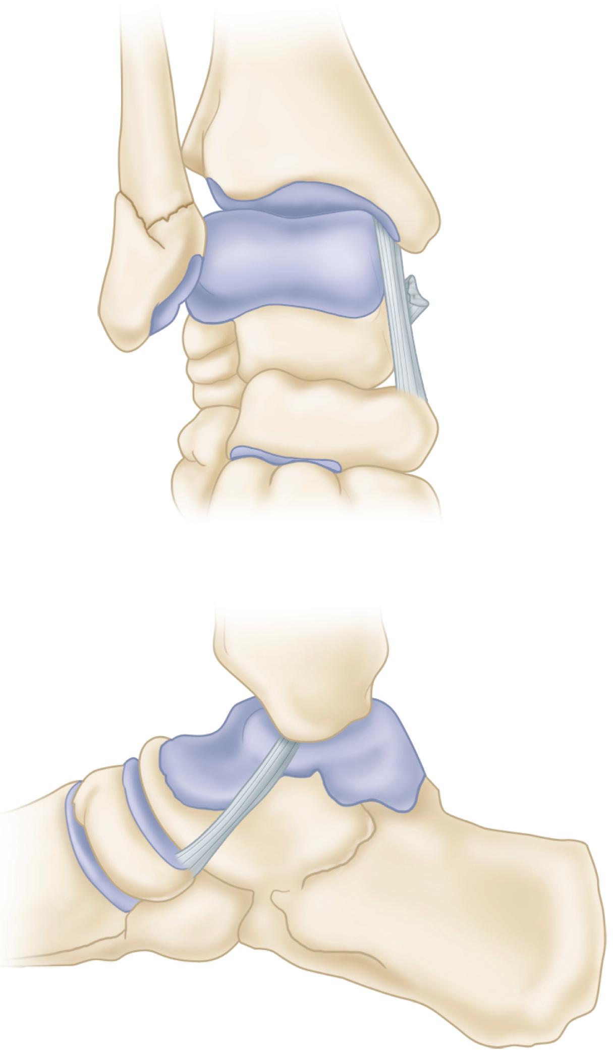 FIGURE 54.9, Trapping of posterior tibial tendon between medial malleolus and talus. Note widening of ankle mortise and avulsion fracture of medial malleolus.