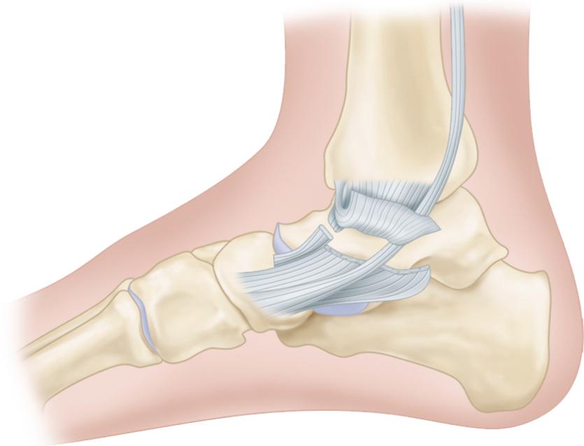 FIGURE 54.10, When deltoid ligament has been avulsed from its distal insertion, it may become reflected proximally and allow posterior tibial tendon to become interposed as shown. Spontaneous healing of ligament is impaired.