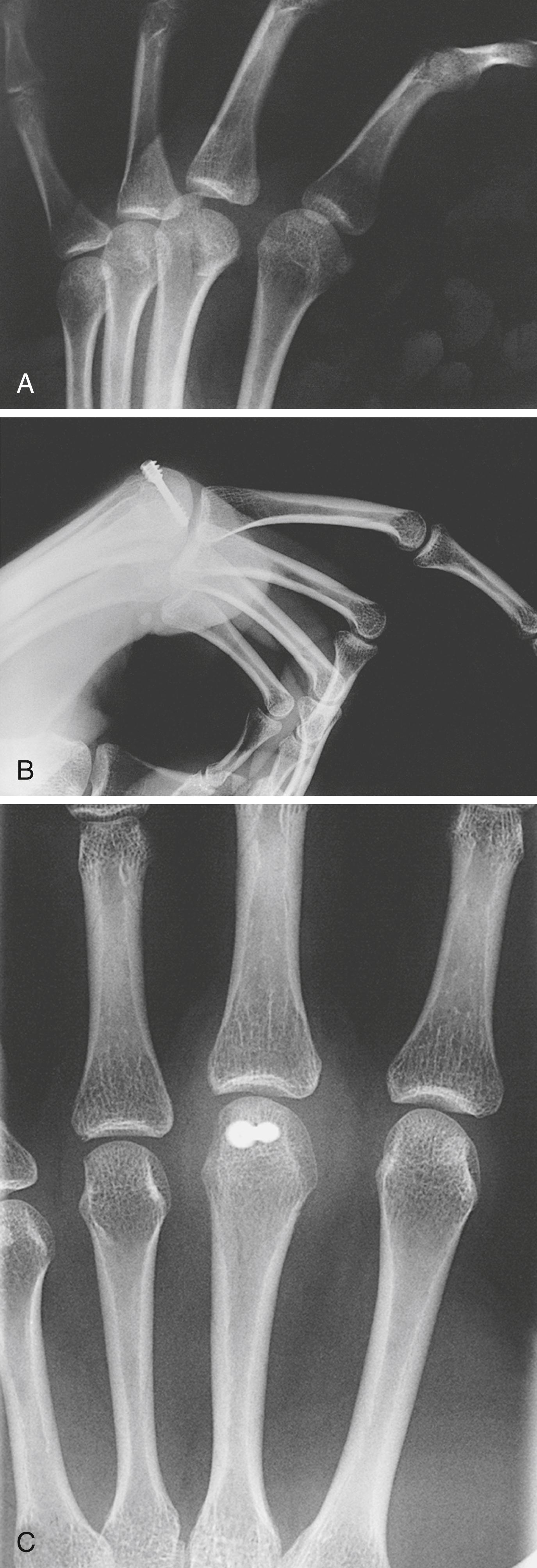 Fig. 7.1, A, Displaced, articular sagittal slice fracture of middle finger metacarpal head. B and C, Postoperative posteroanterior (B) and lateral (C) views show anatomic reduction and fixation with headless screw. Full MCP mobility was restored.