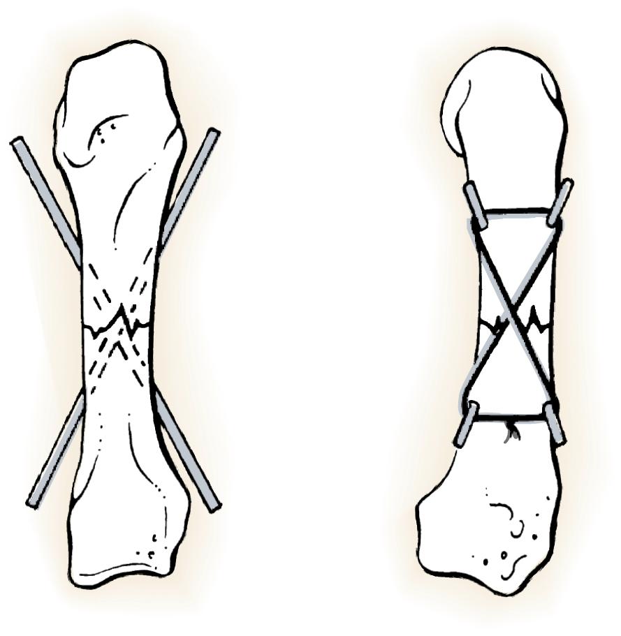 Fig. 7.11, Technique for Kirschner pin fixation of metacarpal shaft fractures. Crossed pins (left) and supplemental 25-gauge stainless steel wire (composite wiring) (right) .