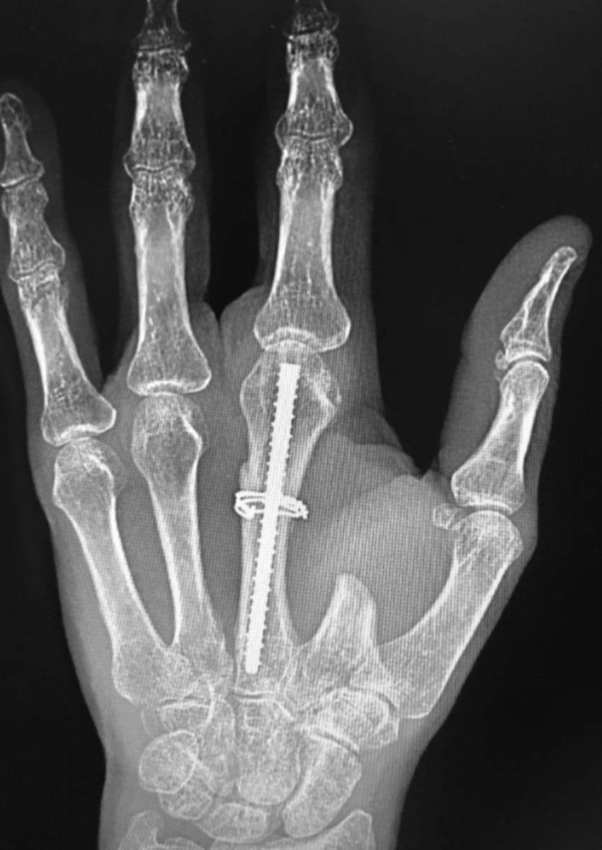 Fig. 7.12, A cerclage wire utilized to augment IM screw fixation following an index transposition for a long finger ray amputation.