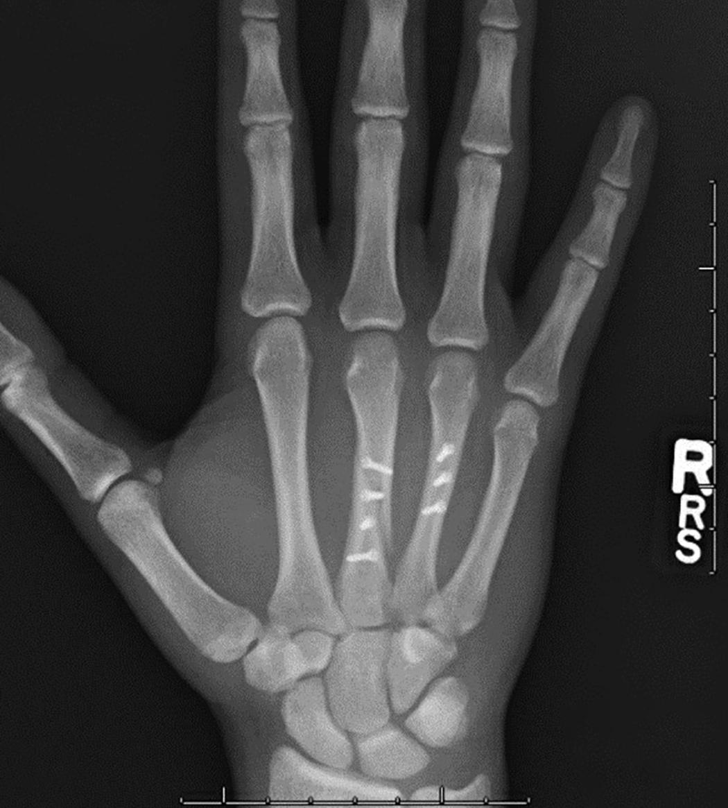 Fig. 7.13, AP radiograph demonstrating internal fixation of long and ring metacarpal fractures using multiple interfragmentary lag screws.