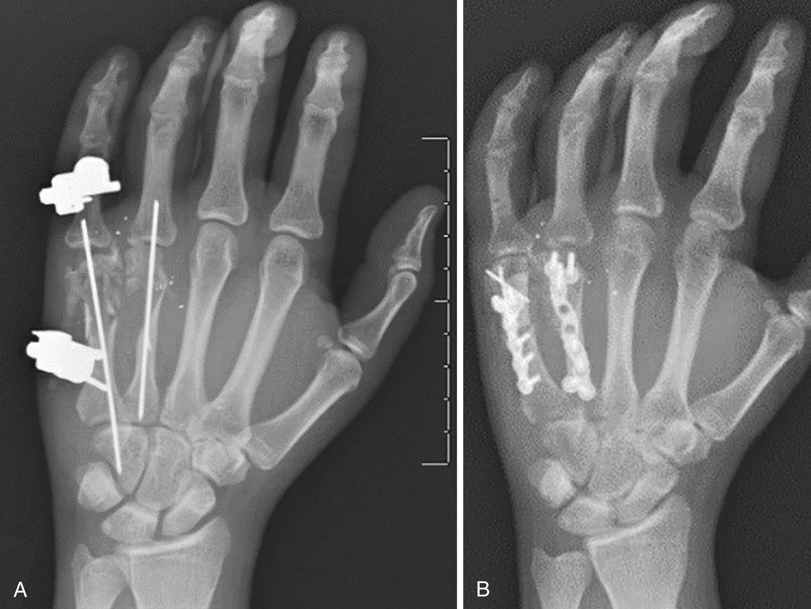 Fig. 7.16, A, AP x-ray demonstrating use of an external fixator in addition to a longitudinal Kirschner wire for temporary management of a complex fifth metacarpal shaft and neck fracture from a gunshot wound. B, ORIF with bone grafting of the fourth and fifth metacarpal fractures following temporizing external fixation.