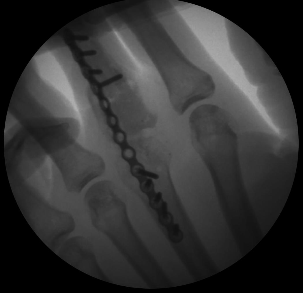 Fig. 7.17, AP radiograph showing the use of a bridge plate as an “internal fixator” following a complex metacarpal head and proximal phalangeal base fracture.